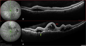 Left eye: (A) On diagnosis. (B) Seven days after diagnosis.