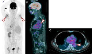 18F-FDG PET/TC of a patient with PMR and LVV. (A) 18F-FDG PET/TC imaging showing major inflammation of the shoulders. (B) Saggital slice. Note the grade 2 metabolic activity of lineal distribution in the aorta. (C) Axial slice. Note the grade 2 metabolic activity of lineal distribution in the thoracic aorta.