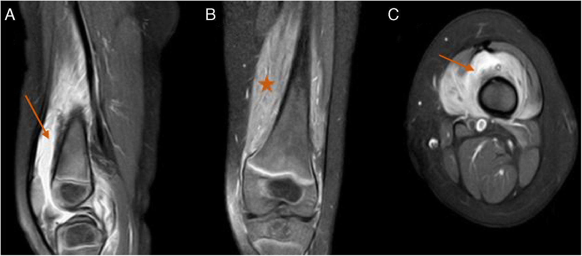 Muscular Abscess Pyomyositis presenting as septic arthritis | Reumatología Clínica