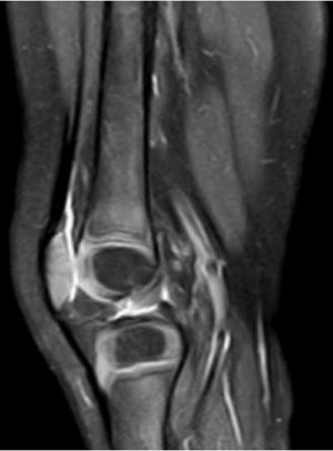 MR of the left knee, STIR sequences with IVC, sagittal slice. No findings of interest.