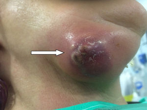 Massive right submandibular abscess (white arrow).
