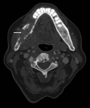 Extensive area of osteonecrosis in right half jaw region (white arrow).