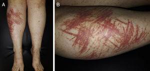 (A) Palpable purpuric lesions on both lower limbs, grouped in a linear and confluent distribution. (B) Detail of the lesions on the right pre-tibial area.