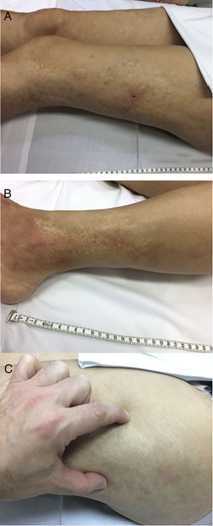 Multiple images of lower limb linear distribution indurated plaques, compatible with linear localised morphea: (A and B) sclerotic plaques with a pearly cream or whitish centre and violacious erythematous periphery, oedematous in lower left limb, compatible with active lesion; (C) image A lesion with demonstrable induration when pressed digitally; (D and E) extensive whitish scar-like plaques in the lower right limb, compatible with non active lesion.