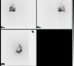 Scintigraphic imaging post intra-articular joint injection with Ytrium-90 of the knee in a 51-year-old male patient with rheumatoid arthritis.