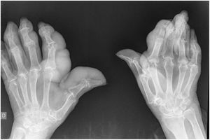 X-ray image of hands: increased soft parts and erosion.