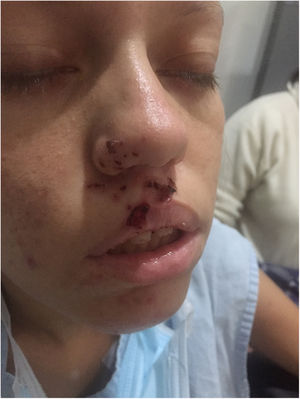Palpebral ptosis in the initial evaluation of the patient and herpes lesions.