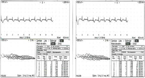 Significant electrodecremental response (>10%) of amplitude when comparing the first stimulation to the following ones.