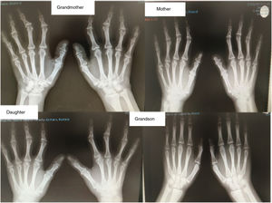 Cone-shaped epiphysis.