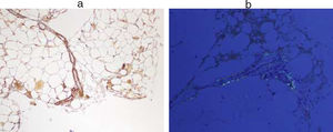 Abdominal fat: (a) Amyloid AA. (b) Congo-red staining.