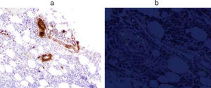Bone marrow: (a) Amyloid AA. (b) Congo-red.