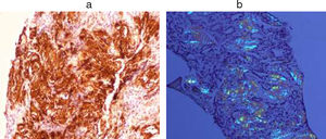 Renal biopsy: (a) Amyloid AA. (b) Congo-red.