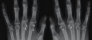 AP X-ray of the hands showing severe degenerative changes in a patient with hereditary haemochromatosis. It can be observed that the changes are more aggressive in the 2nd and 3rd metacarpophalangeal joints bilaterally with reduced joint space, subchondral sclerosis, and hook-like osteophytes in the radial area (*).