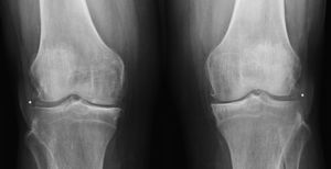 AP X-ray of the knees. Showing radiological chondrocalcinosis (*), reduced joint space, subchondral sclerosis and marginal osteophytes.