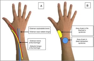 (A) Anatomical path of the tendons involved in distal intersection syndrome. (B) Site of pain in distal intersection syndrome and in De Quervain