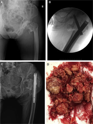 A. Simple X-ray of the left hip, anteroposterior projection, showing perthrocantheric fracture. B. Intraoperative fluoroscopy, anteroposterior projection, showing intramedullary nailing of the proximal femur. C. Simple X-ray of the left hip, anteroposterior projection, showing failure of the intramedullary nailing with luxation of the femoral head. D. Macroscopic appearance of the osteochondromatosis nodules sent to pathological anatomy.