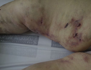 Clinical image of the skin lesions.