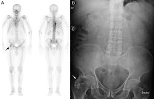(A) Complete whole-body anterior and posterior bone scan with 99mTc-HDP. (B) Simple AP X-ray of the abdomen.