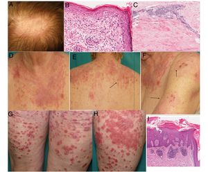 (A) Alopecic erythematosus plaque in scalp with flaking. (B) Biopsy of the scalp plaque: orthokeratotic hyperkeratosis, thickening of the basement membrane, vacuolar degeneration and apoptotic keratinocytes (haematoxylin–eosin 400×). (C) Biopst of the lumbar skin induration showing marked thickening of the septum, hyalinisation of collagen bundles and perivascular lymphoplasmocytic infiltration compatible with morphea. Absence of lobulillar panniculitis, hyaline fat necrosis, calcification focal points and lymphoid follicles ruling out lupus panniculitis (haematoxylin–eosin 200×). (D–F) Erythematodematosus plaques in areas exposed to sunlight with erosive and necrotic areas (arrows): SACLE. (G and H) Erythematosus plaques in thighs: plaque psoriasis. (I) Biopsy of a plaque: hyperkeratosis, parakeratosis, Munro