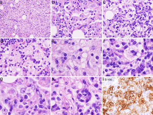 (a, b, c, d) H&E stain low power: infiltration of the dermis or subcutaneous tissue with associated sclerosis: histiocytes, lymphocytes and fibrosis is in the background. Admixed with these large histiocytes there are lymphocytes, plasma cells, neutrophils and eosinophils. (e, f, g, h) High power of the H&E sections: histiocytes containing lymphocytes and plasma cells within a slightly eosinophilic cytoplasm, foam cell with bubbly palely eosinophilic cytoplasm abundantly granular with open vesicular nuclei with prominent nucleoli. (i) S100 stain highlights the macrophages and histiocytes seen on the H&E stain. Lymphocytes, and stained histiocyte containing other cells (emperipolesis) known also as the Rosai–Dorfman (RD) cell.