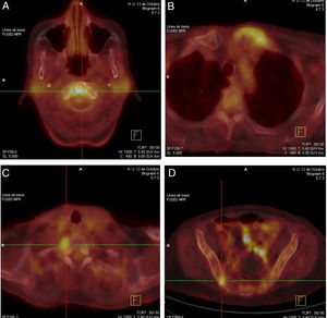 Increased uptake of the radiopharmaceutical product (18F-FDG) in PET-CAT at atlantoaxial joint (A), left sternoclavicular joint (B), right costovertebral joint in T1 (C) and right sacroiliac joint (D) levels.