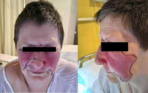 Erythematous lesions with well-defined border on the nose, malar, periorbital regions and on the upper lip. The limits of the lesions were drawn to better observe how they evolved.
