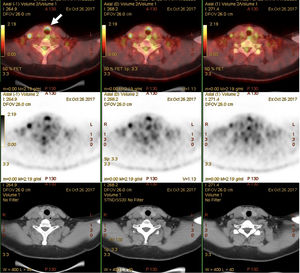 Laryngeal uptake (arrow) in the 18F-FDG PET/CT scan.
