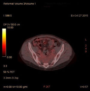 PET-CT scan image with 18F-FDG showing presacral capture with little glucidic avidity.