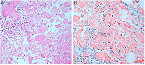(A) Deposits in lamina propria of eosinophilic amorphous material and in the capillary walls (HE, 20×). (B) Congo red staining showing intensely positive deposits of amyloid material, which showed apple-green birefringence with polarised light (Congo red, 20×).
