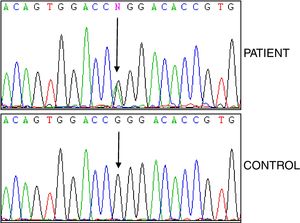 p.R92Q mutation in heterozygosis. Exon 4, TNFRSF1A gene.