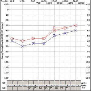 Audiometry: Tonal audiometry showing a drop in both air and bone conduction, a sign of sensorineural hearing loss.