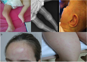 (a) The view of the arthropathy and rash of CINCA patient. (b) The view of the rash of FCAS patient.
