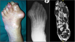 The figure depicts three different cases of foot involvement in tophaceous gout, shown by a clinical picture (left), plain radiography (center) and T1-weighted magnetic resonance (right).