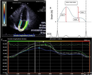 A) Four-chamber apical view image where the edges of the left atrium are determined for strain calculation. B) Graphical representation of the left atrium strain in the whole atrium cycle. The ALSr corresponded to the value from the highest peak of the reservoir phase, the ALSb to the highest peak of the booster pump phase and the ALSc to the difference between ALSr and ALSb. C) Representation of the strain report of the left atrium of the VVI software.