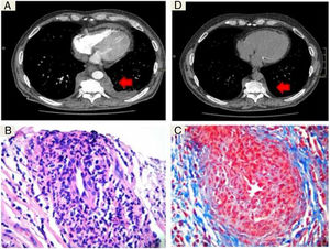 A) Computed tomography with intravenous contrast showing a dorsal paravertebral mass of soft tissues (arrow) which extends to the extrapleural space, without calcifications or bone involvement. B) Fragment of fibroconnective tissue that shows vascular elements with abundant intramural inflammatory infiltrate and reduction in the calibre of openings (H&E ×10). C) Artery with dense mixed inflammatory infiltrate composed of lymphocytes and polymorphonuclear neutrophils, prominent endothelial cells and a narrowed opening (Masson ×40). D) Computed tomography without contrast at check-up, showing a reduction in the lesion after 4 months of treatment.