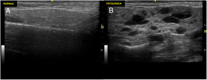 Ultrasound scan image of normal parotid and one of a patient with Sjögren's syndrome. Ultrasound scan images showing parotid glands with normal and pathological parenchyma. A). Ultrasound image of a normal parotid. B). Changes marked grade 3 according to the OMERACT index: diffuse loss of parenchymal homogeneity with hypo/anechoic areas that occupy the whole glandular surface, without normal tissue.
