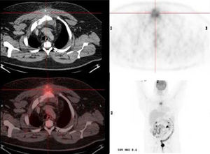 Thoracic computed tomography scan shows destructive sternal bone lesion associated with a soft tissue mass (approximate size 96mm×71mm×53mm) with a hypermetabolic lytic lesion at the manubrium-sternal junction, associated to a mass of perilesional soft. tissues, and infiltration of the upper mediastinal fat with a SUV max value of 8.6.