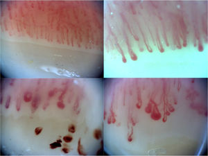 Examples of capillaroscopic patterns: pattern of normality (a), of early scleroderma with afferent and efferent capillary loop dilatations (b), of active scleroderma with micro-haemorrhages (c) and of delayed scleroderma with avascular areas, dilatations and neoangiogenesis (d).