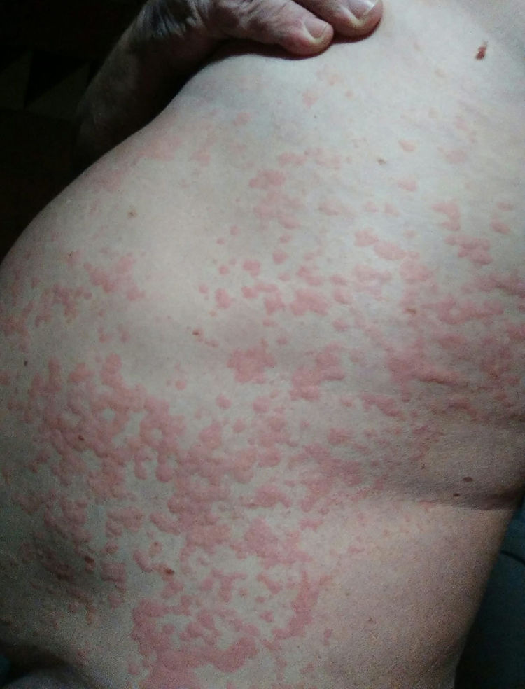 Autoimmune Rashes Two difficult management autoimmune diseases | Reumatología Clínica