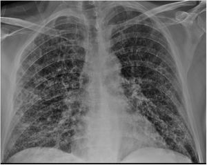 Chest x-ray on admission bilateral alveolar infiltrations with a ground glass pattern.