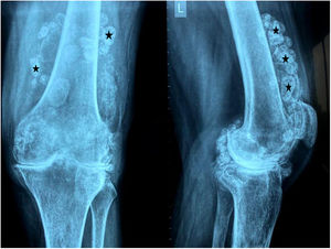 Anteroposterior and lateral radiographs of knee. Multiple loose calcified bodies are seen within it (asterisks).