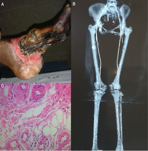 A: Dry Gangrene of left foot converted into wet gangrene demanding for transmetatarsal amputation. B: CT Angiography showing filling defects. C: Biopsy of Involved Skin depicting changes consistent with Vasculitis.