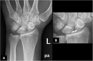 Posteroanterior plain radiograph of the left wrist (A) with magnified detail (B). There is a significant diastasis between the lunate and scaphoid bones of the carpus (double-headed arrow), which in the manual measurement was 3.5 mm. In addition, a rotatory subluxation of the scaphoid bone (B) is seen, which is an indirect indicator of scapholunate ligament injury, although it is visible in other injuries of different wrist stabilisers.
