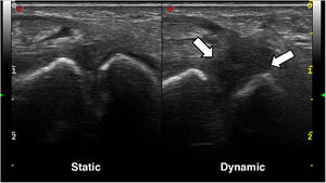 Ultrasound images of the wrist with a high-frequency linear probe; dorsal approach. In the static scan (left image), the scapholunate space appears to be preserved, although a certain hypoechogenicity of the scapholunate ligament can be sensed. However, in the dynamic scan (right image), there is a marked hypoechogenicity with significant scapholunate diastasis, without identifying the ligament with definition, in the context of its rupture.