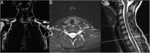Coronal (A), axial (B) and sagittal (C) MRI of the cervical spine. The coronal recordings are Dixon sequences where fat is emphasized (A), the axial and sagittal recordings are Dixon sequences where water is emphasized (B, C). (A) Notice more fat in the form of a “teardrop” (white on this image) around the left C8 under the transverse process (arrows), compared to right. (B, C) Hyperintensity around left nerve C8 (arrow), indicating more edema than on the right.