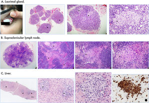 Lacrimal gland enlargement (A, arrow). The lacrimal gland, supraclavicular lymph node and liver slides stained with haematoxylin and eosin showed confluent epithelioid granulomas without necrosis (A–C*). Note the strong histiocytic expression of CD68 in (C).