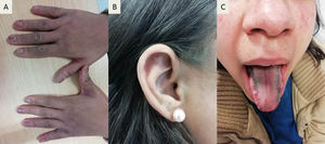 Hydroxychloroquine induced melanosis. Hydroxychloroquine induced melanosis of the nails of the hands (Panel A), the scapha and triangular fossa of the ears (Panel B) and the tongue (Panel C).