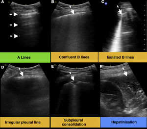 Lung ultrasound findings. (A) Physiological aeration lines A (arrows). (B–E) Findings commonly found in SARS-CoV-2 pneumonia (arrows). (F) Large consolidation or hepatinisation, a common finding in bacterial pneumonia (arrow).