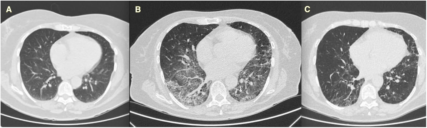 Post-COVID-19 interstitial lung disease: A new treatment challenge in ...