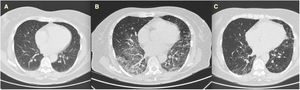 Evolution of the CT scan of the patient.